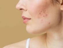 Clinical Dermatology & Severe Acne
