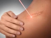 Post-Acne Scar Revision & MNRF